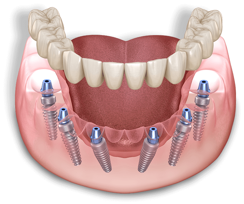 full arch dental implants