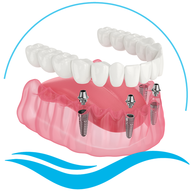 Full mouth Dental implants