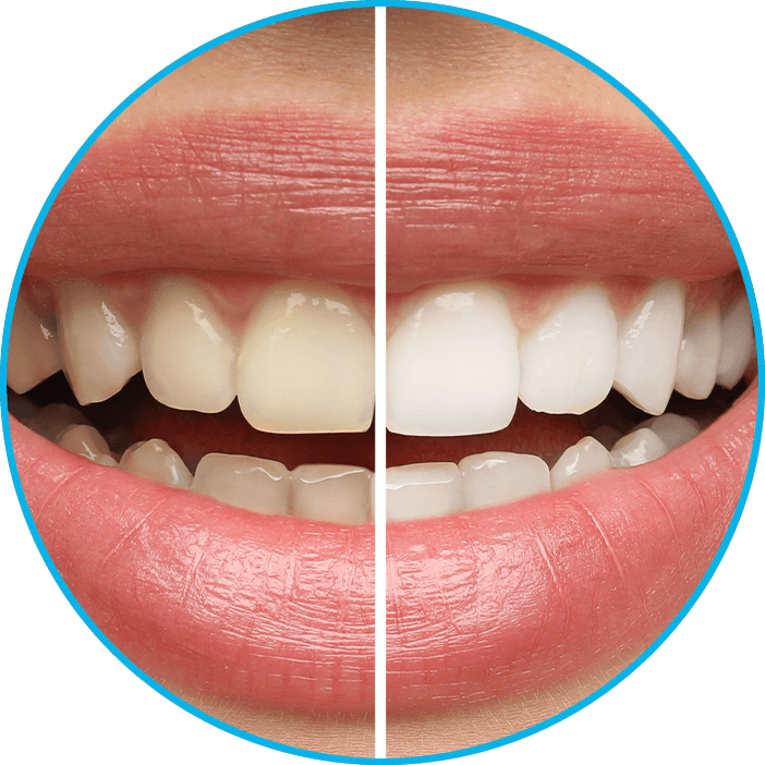 before and after of teeth whitening process