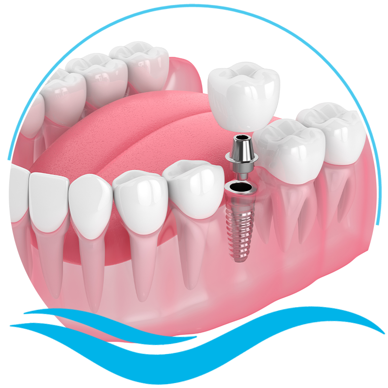 dental implants